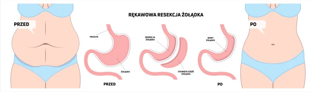 Operacja bariatryczna od jakiego bmi? Sprawdź, czy kwalifikujesz się